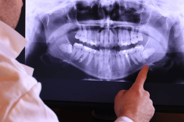 Best Emergency Treatment for Oral Infections in Essexville, MI